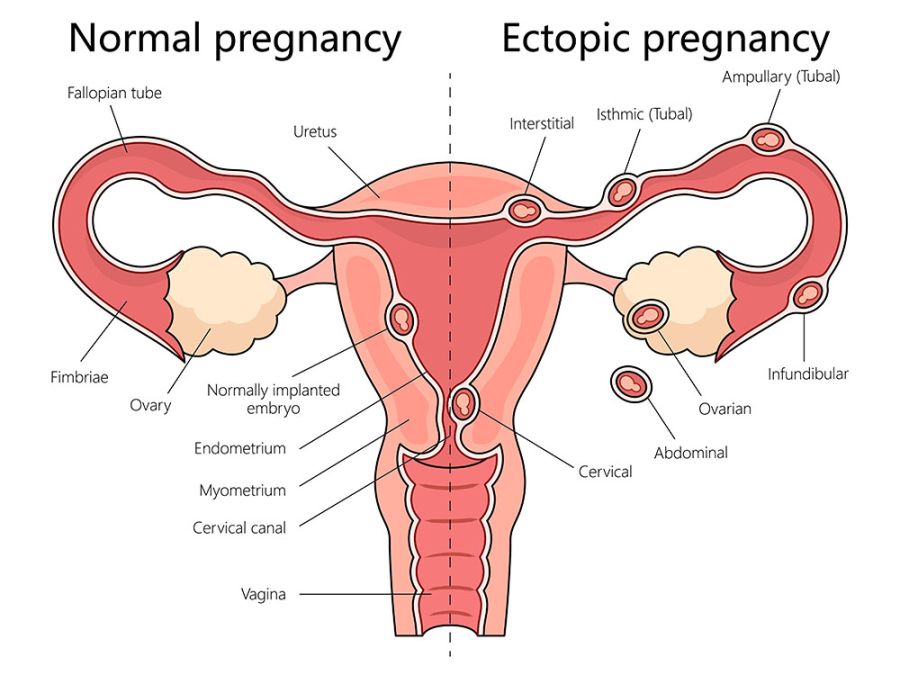 A graphic illustrating the difference between normal and ectopic pregnancies within the female reproductive system.