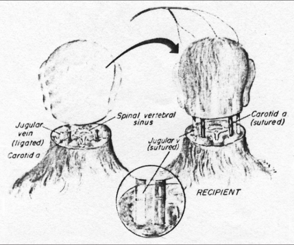 Diagram of a head transplant surgery